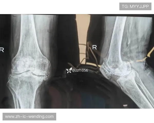 穆迪髌腱伤情更新科尔确认无软骨骨骼损伤手术将相对简化